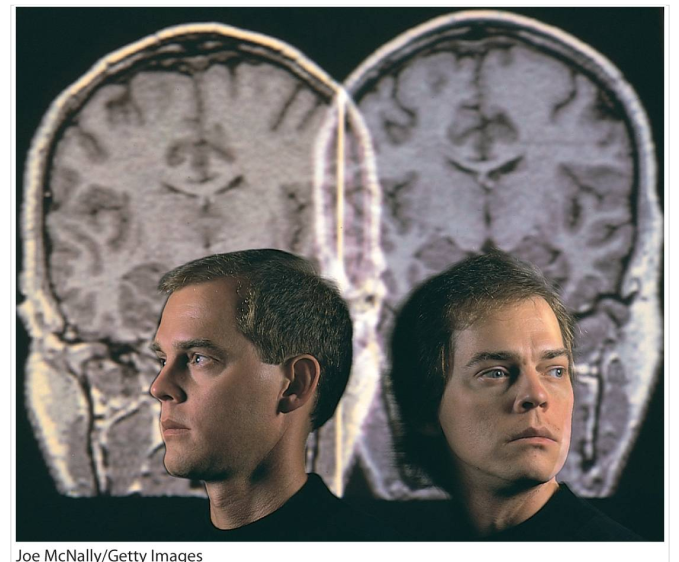 عکس سمت راست مغز یک فرد مبتلا به اسکیزوفرنی است که پیداست بطن‌های مغزی بزرگتری نسبت به مغز سمت چپ که یک فرد سالم است دارد. 